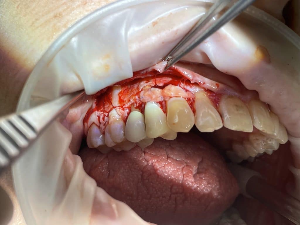 connective tissue graft sutured