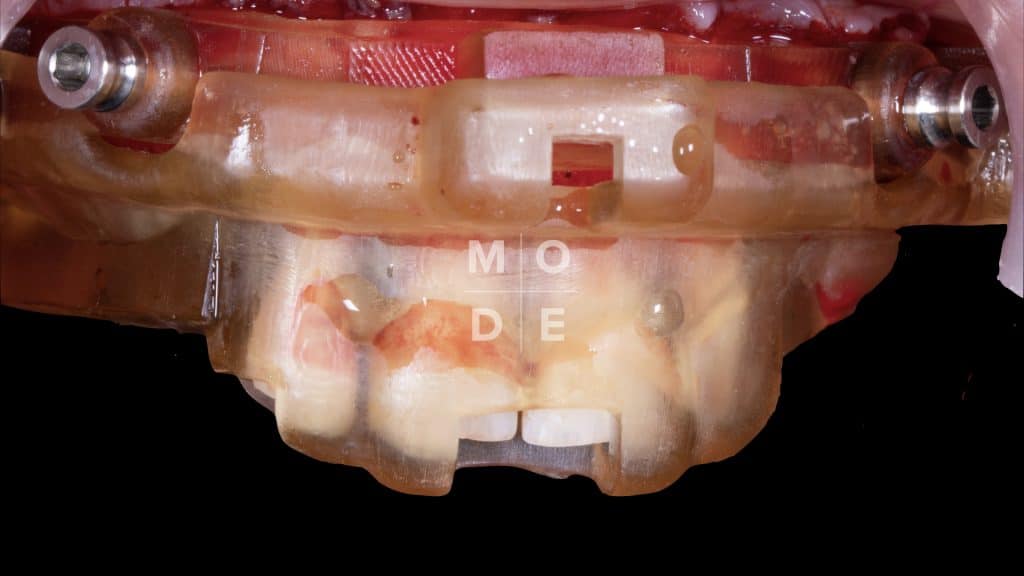 Intra-Oral Stacked Guides 1