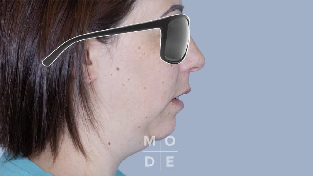 Lateral View Follow Up 3 Months at Rest