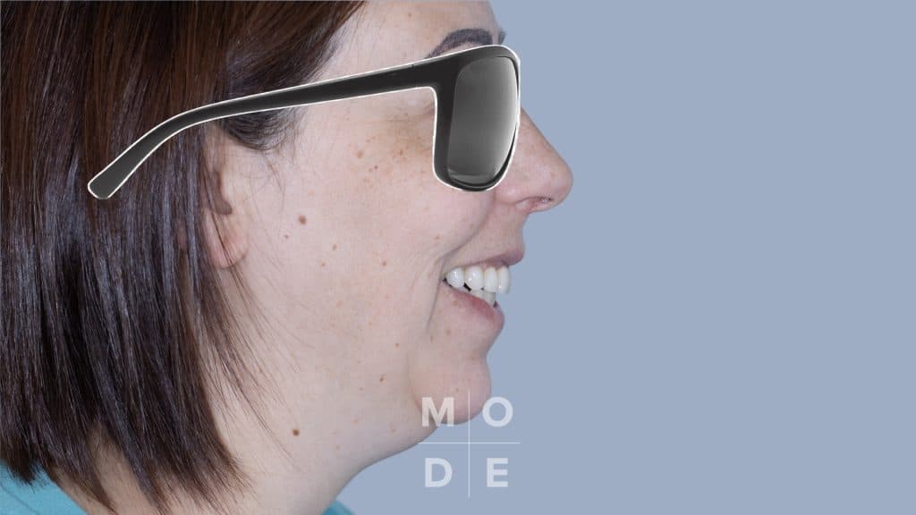 Lateral Smile at Follow Up 3 Months