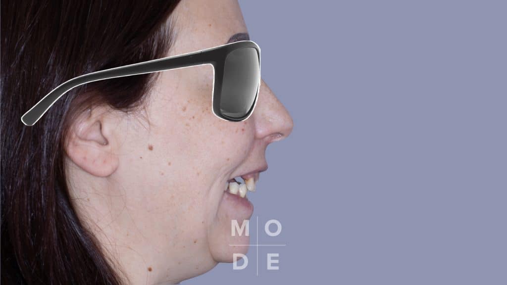 Initial Lateral Smile