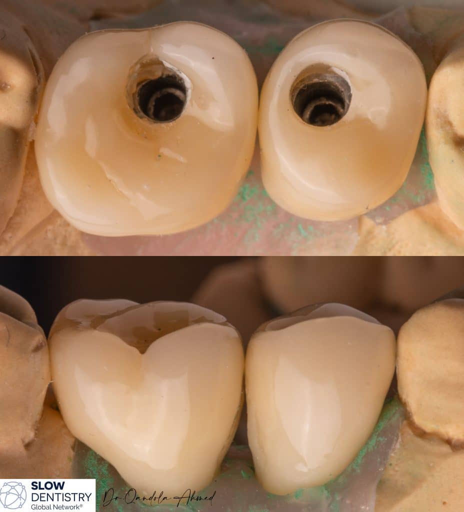2 Seperated Screw Retaind Crowns .
