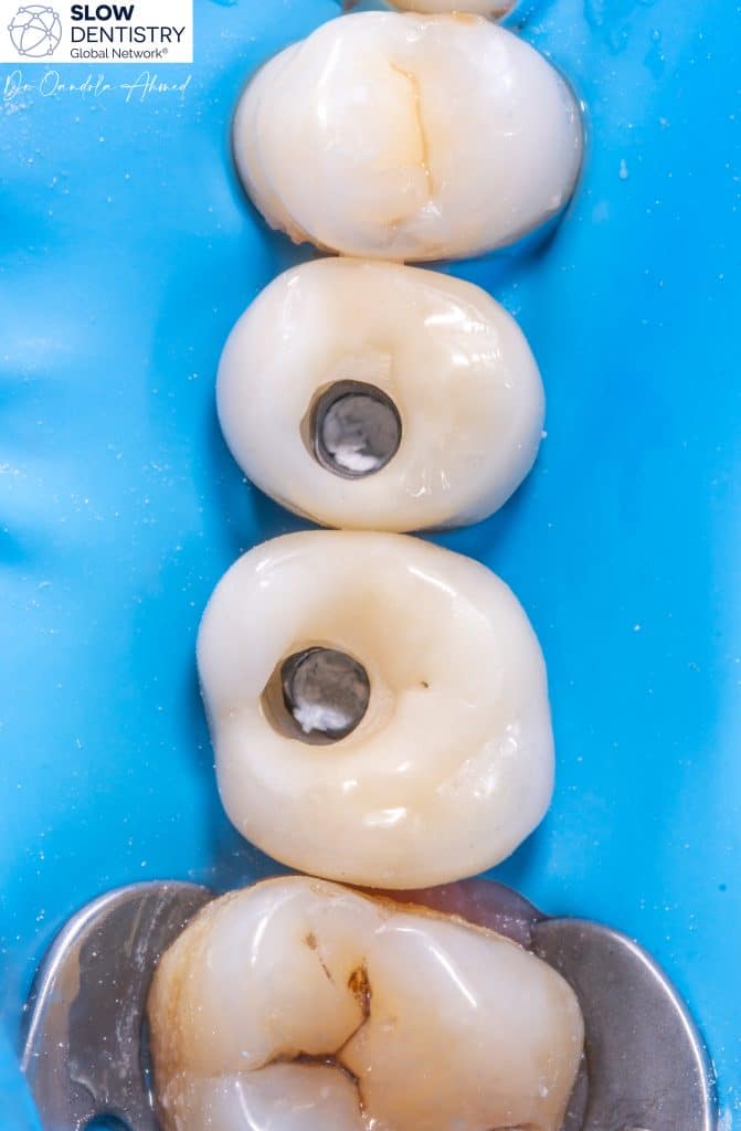 No Rubberdam No Implants 😁