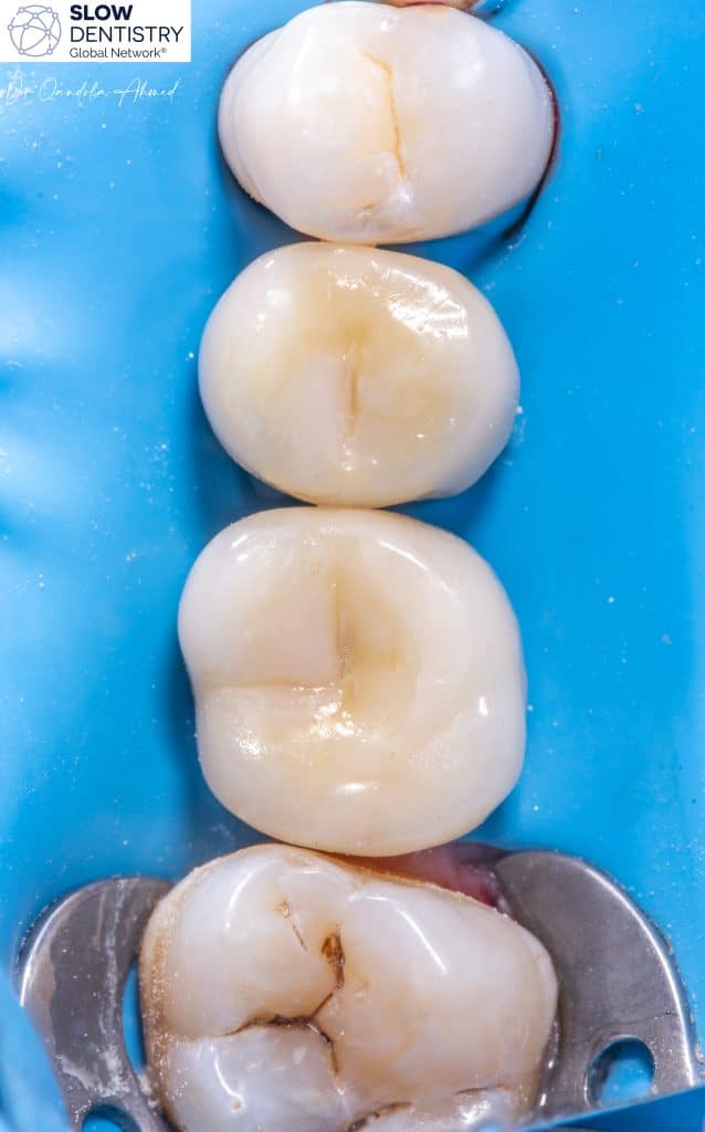 An Expensive Class I Restoration 😁