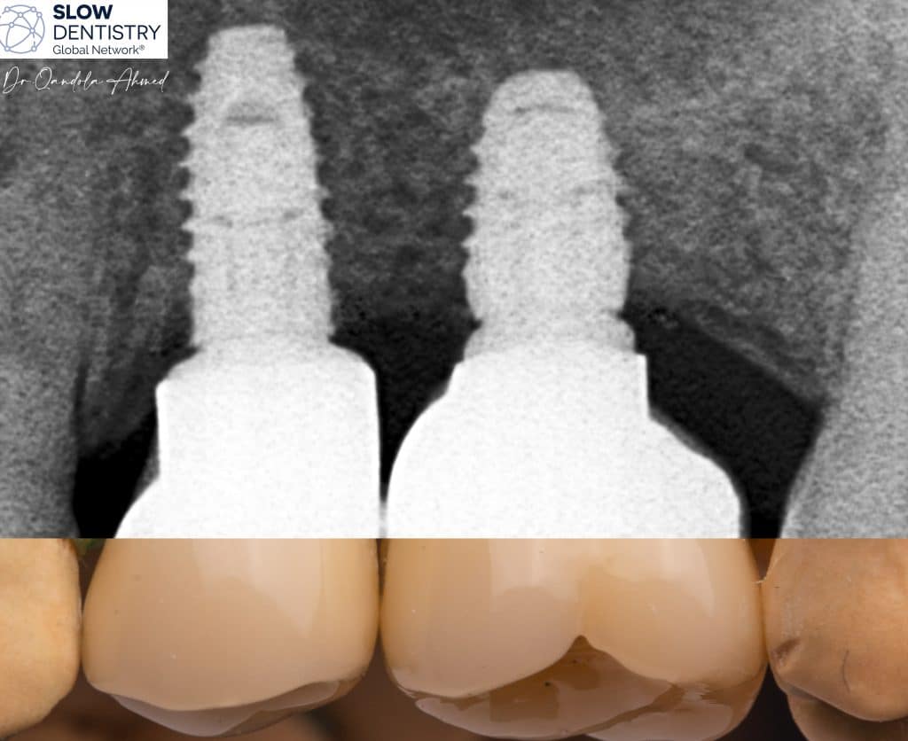 15 Months Follow Up .