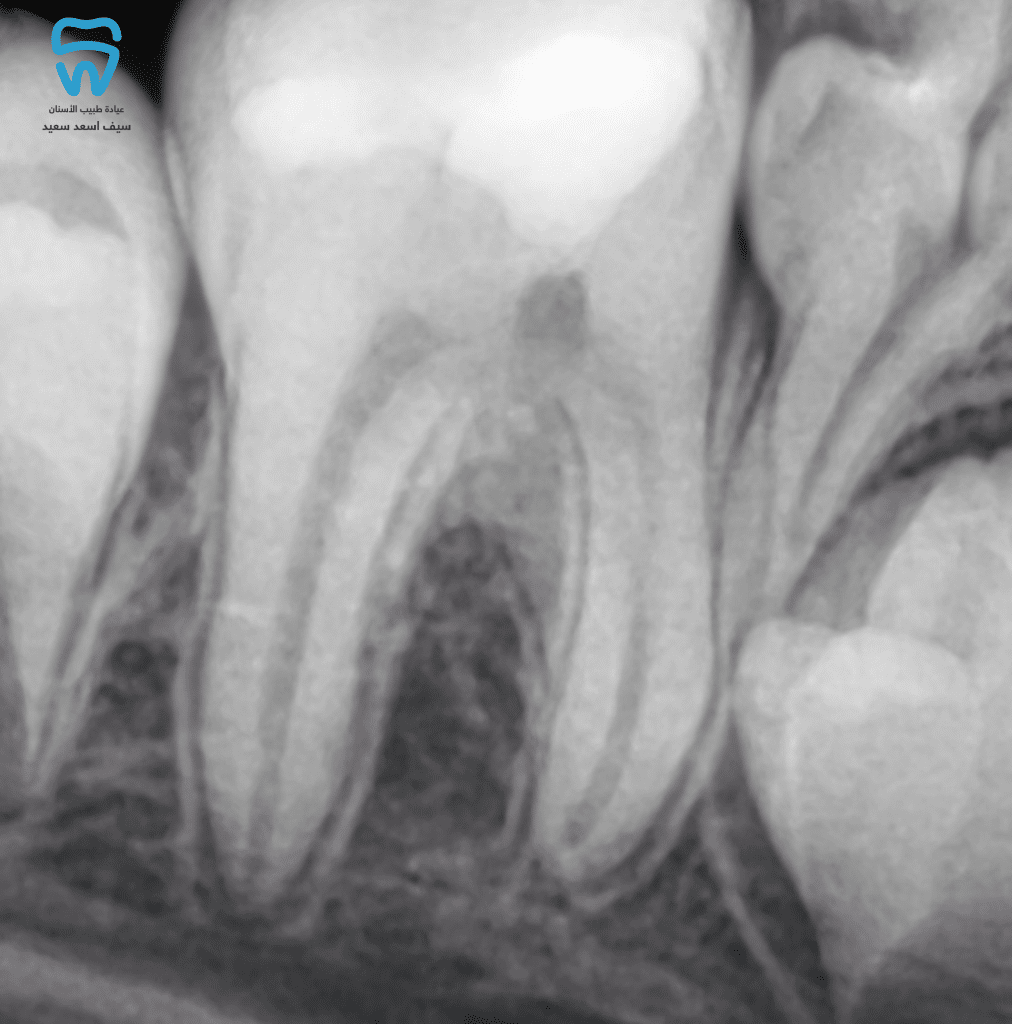 Root maturation 5/2022