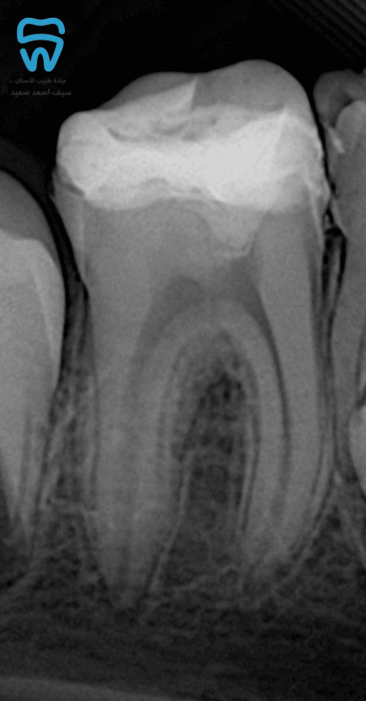 Placement of indirect restoration 8/2022