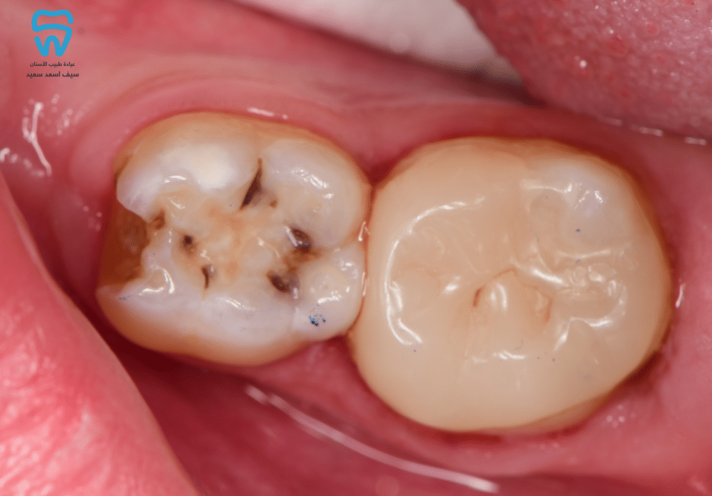 Immediately after placement