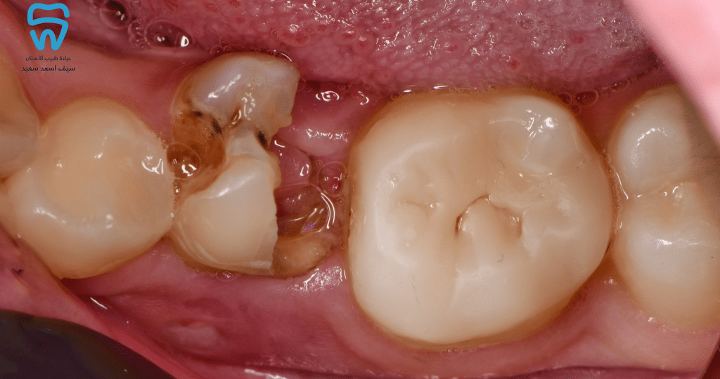 1.5 years follow-up of Indirect restoration
