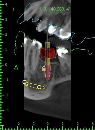 Rafifi zohra-Fatima2-Implant View