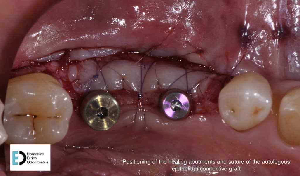positioning of healing abutments and suture