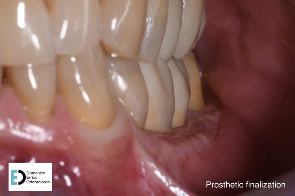 prostethic finalization