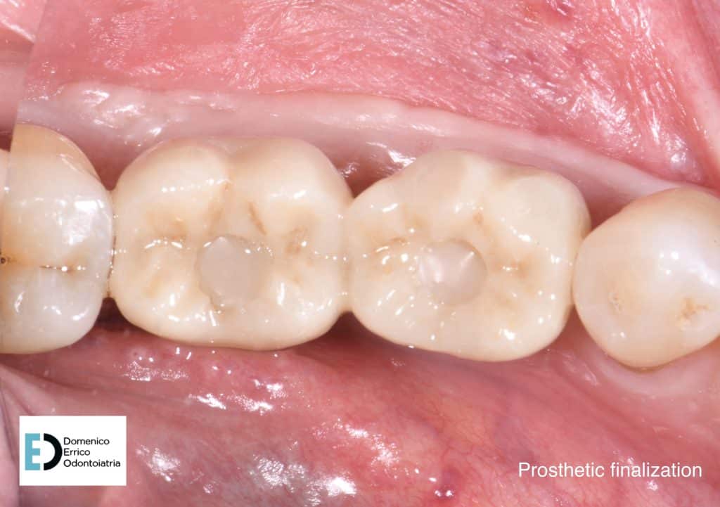 prosthetic finalizaton