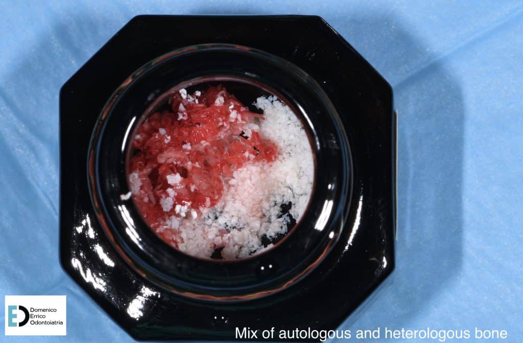 mix of autologous and heterlogous bone