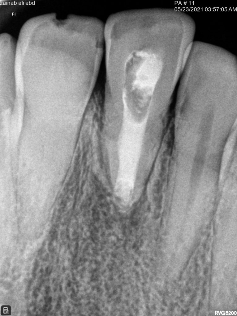 Non setting calcium hydroxide