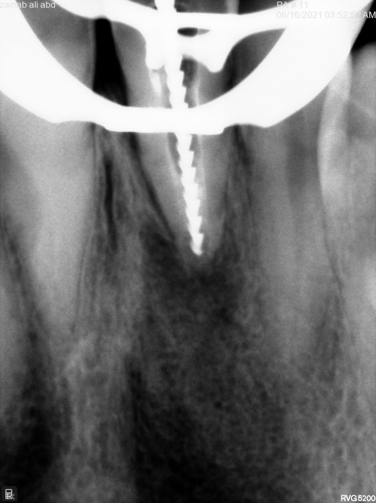 Working length determination