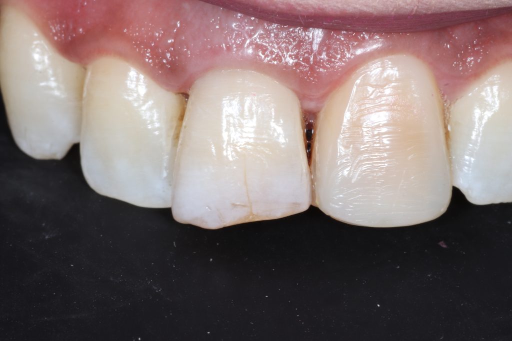 Internal bleaching