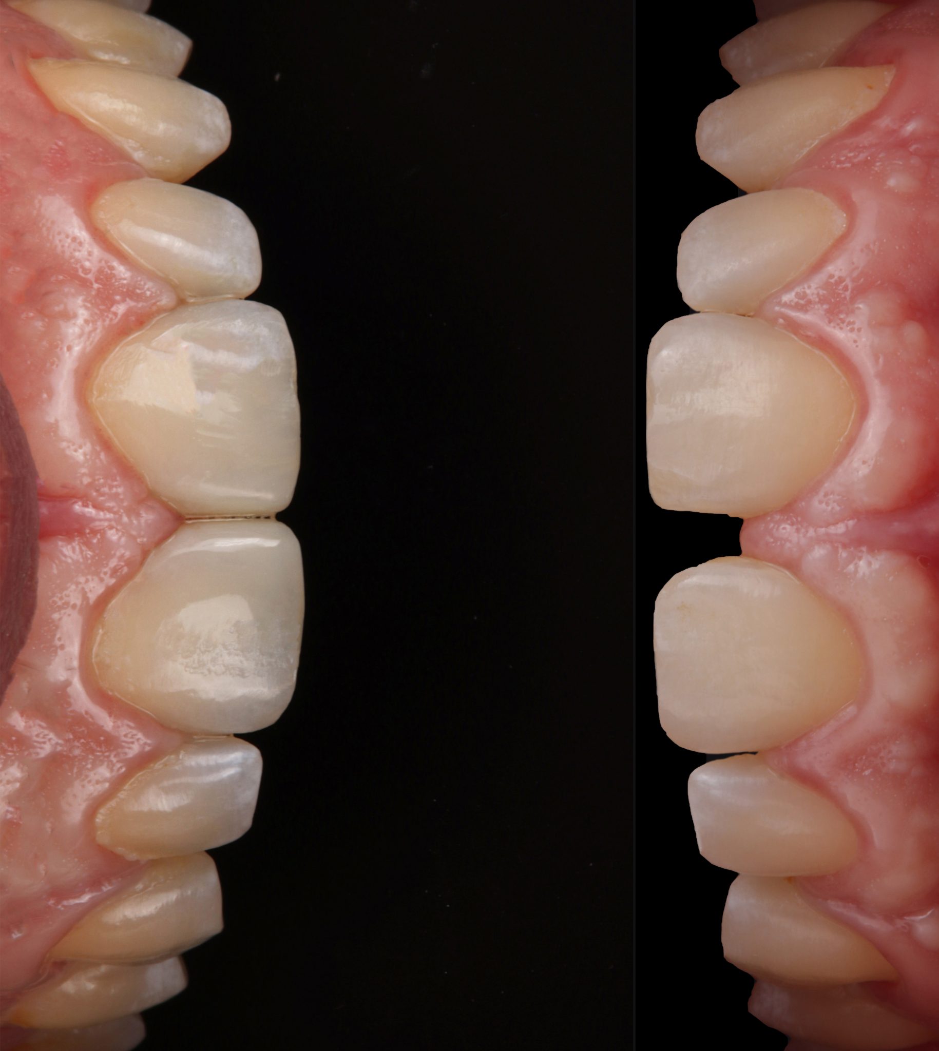 Diastema closure step by step as simple as possible - MyZerodonto