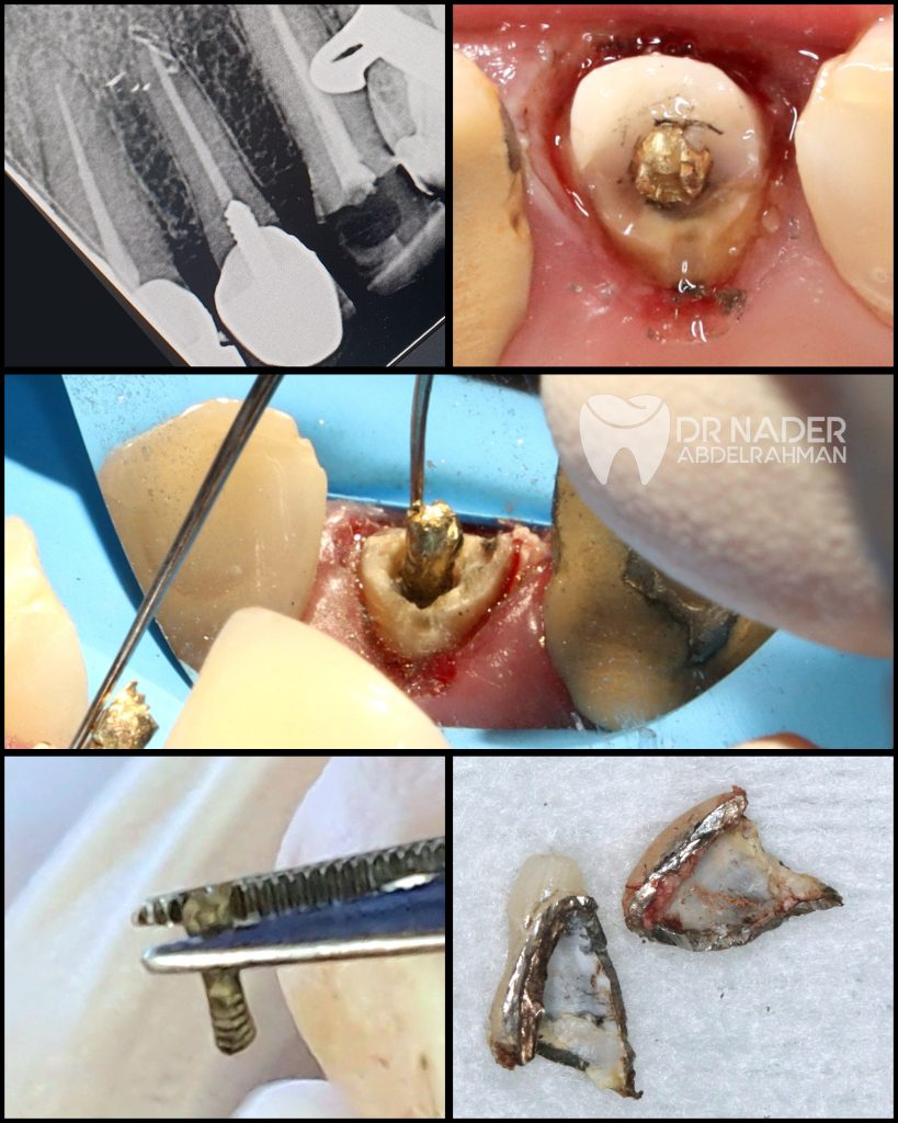 Post Removal Procedure