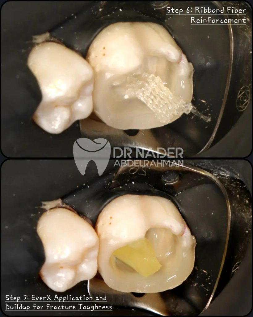 Ribbond and Ever X placment