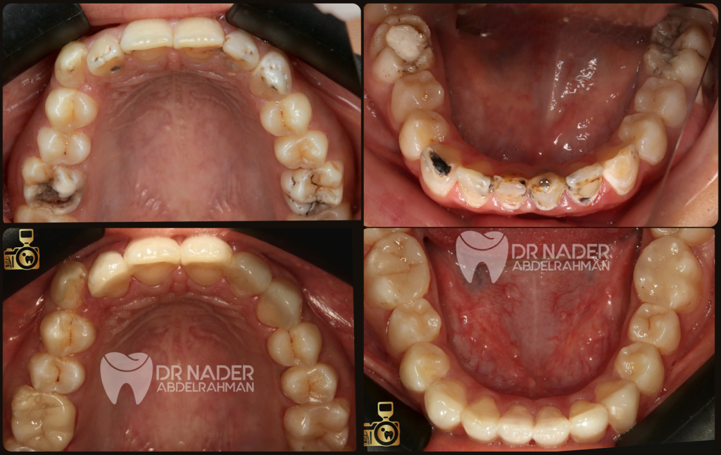 image of upper and lower jaw Occlusal view