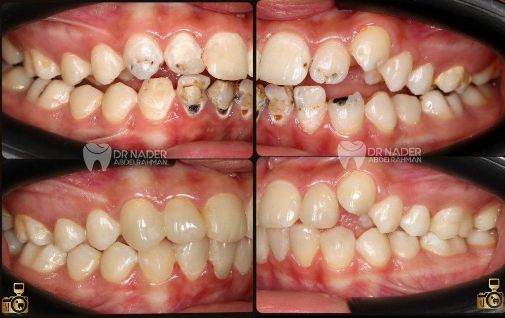 45 degrees intraoral right and left