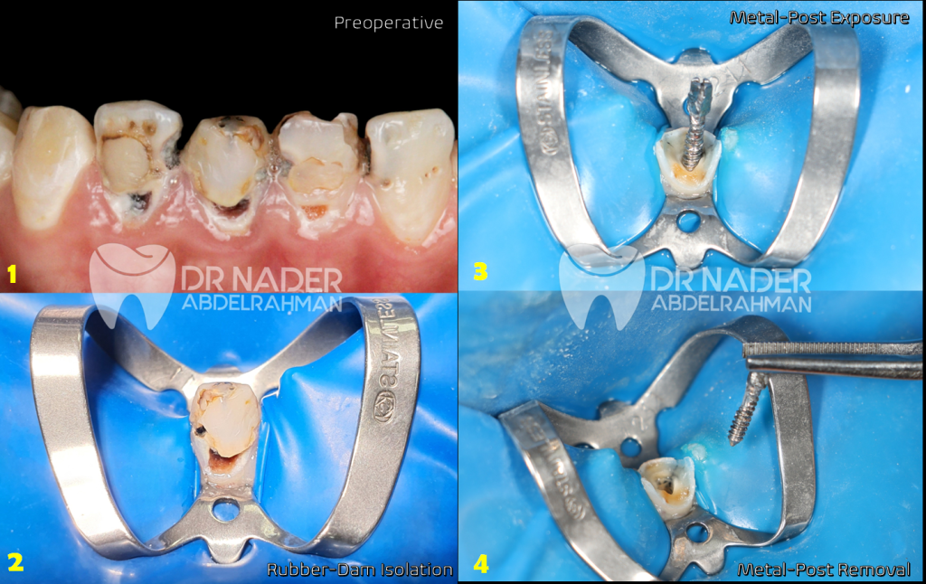 Steps For Custom-made Chairside Fiber post