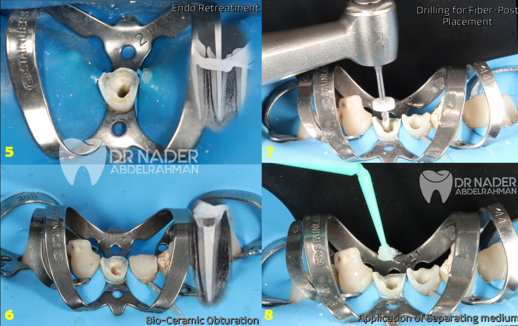 Drilling and Impression of custom Fiber post