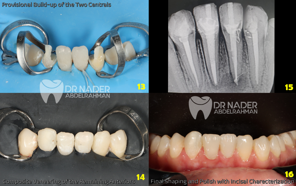 Isolation and Final Radiograph