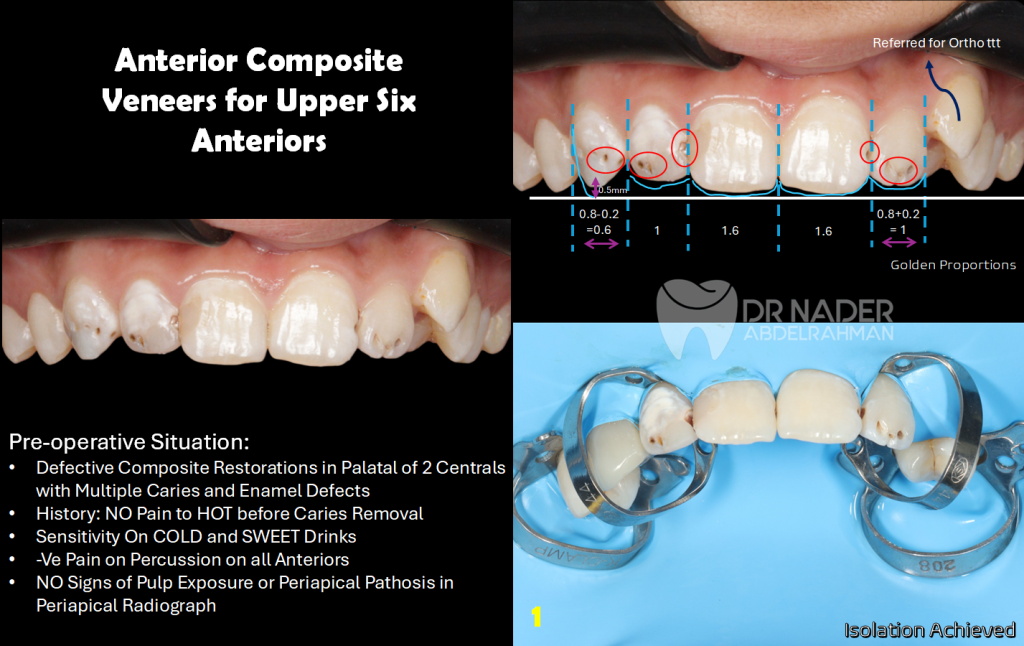 Upper Anterior Composite Veneers