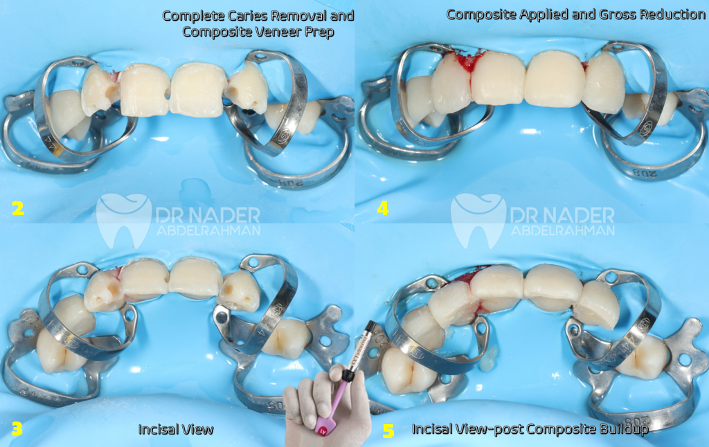 Rubber-dam Isolation