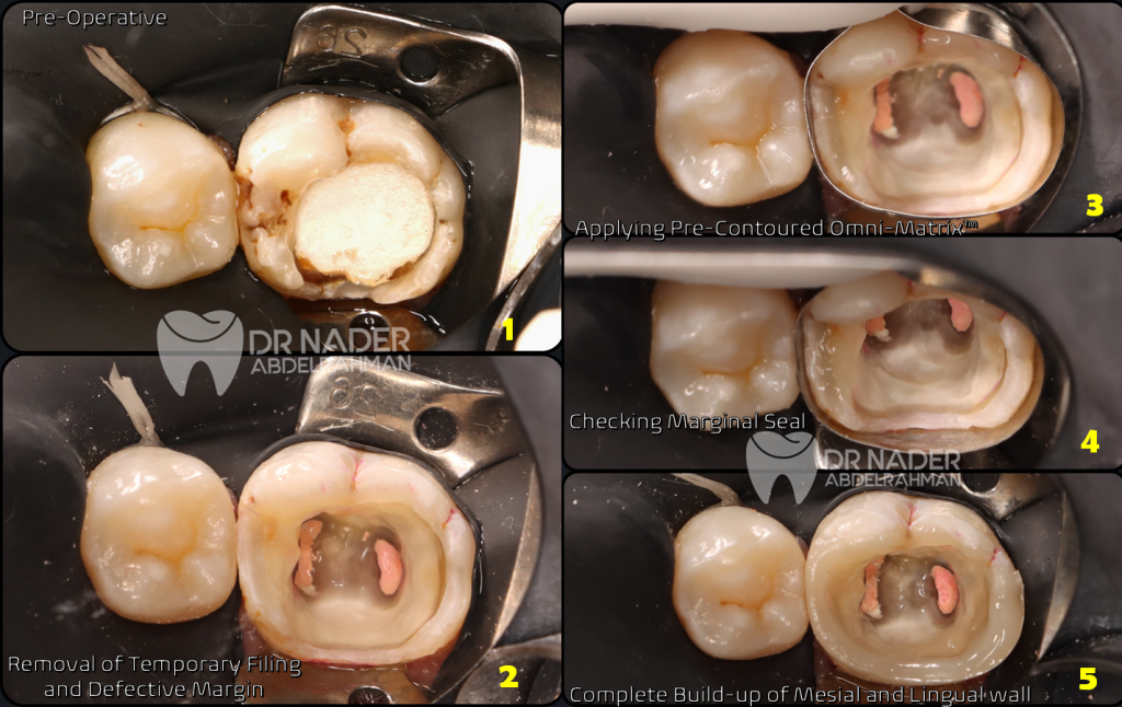 Biomimetic Approach for Permanent Molars
