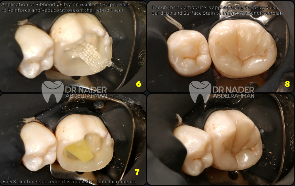 Reinforcement of Restoration
