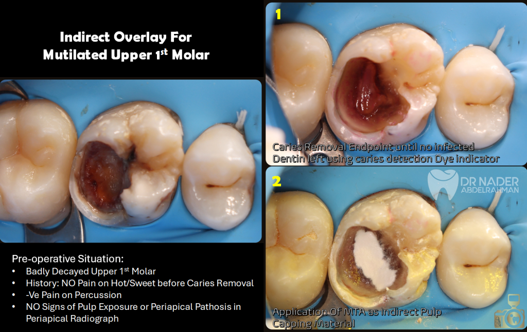 Indirect Overlay Planning