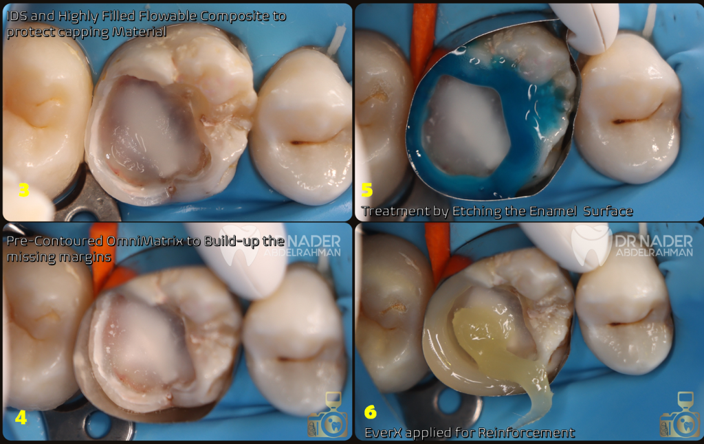 IDS and Pulp Capping