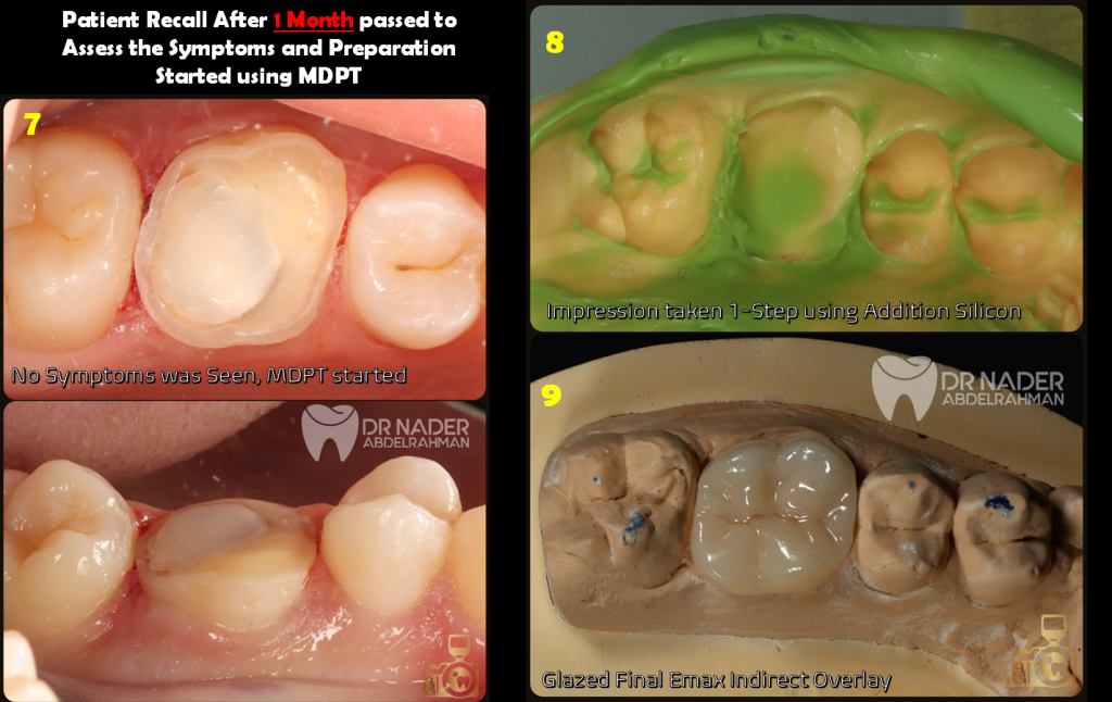 Impression Taking and Overlay preperation