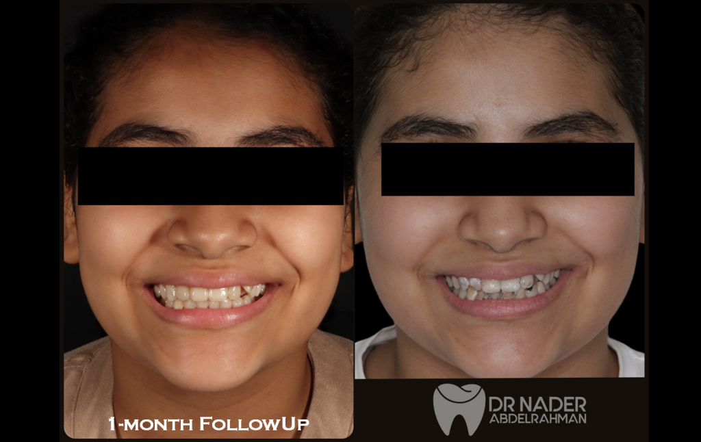 Before and after Frontal Smile- Extraoral