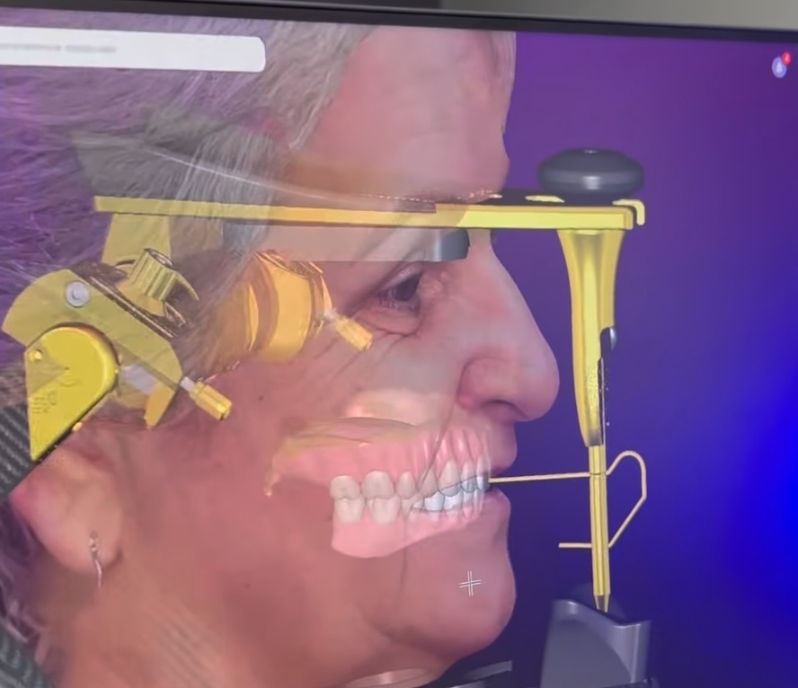 Qlone Dental face in Virtual Articulator