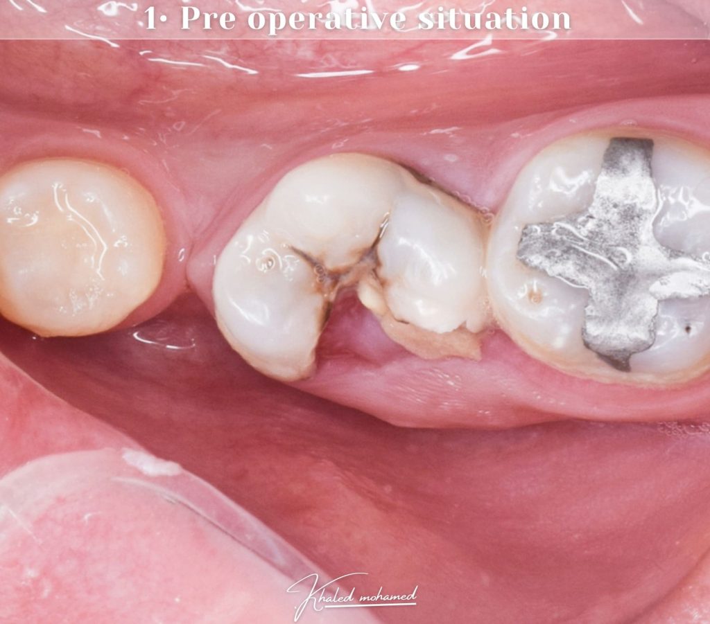 Pre operative situation