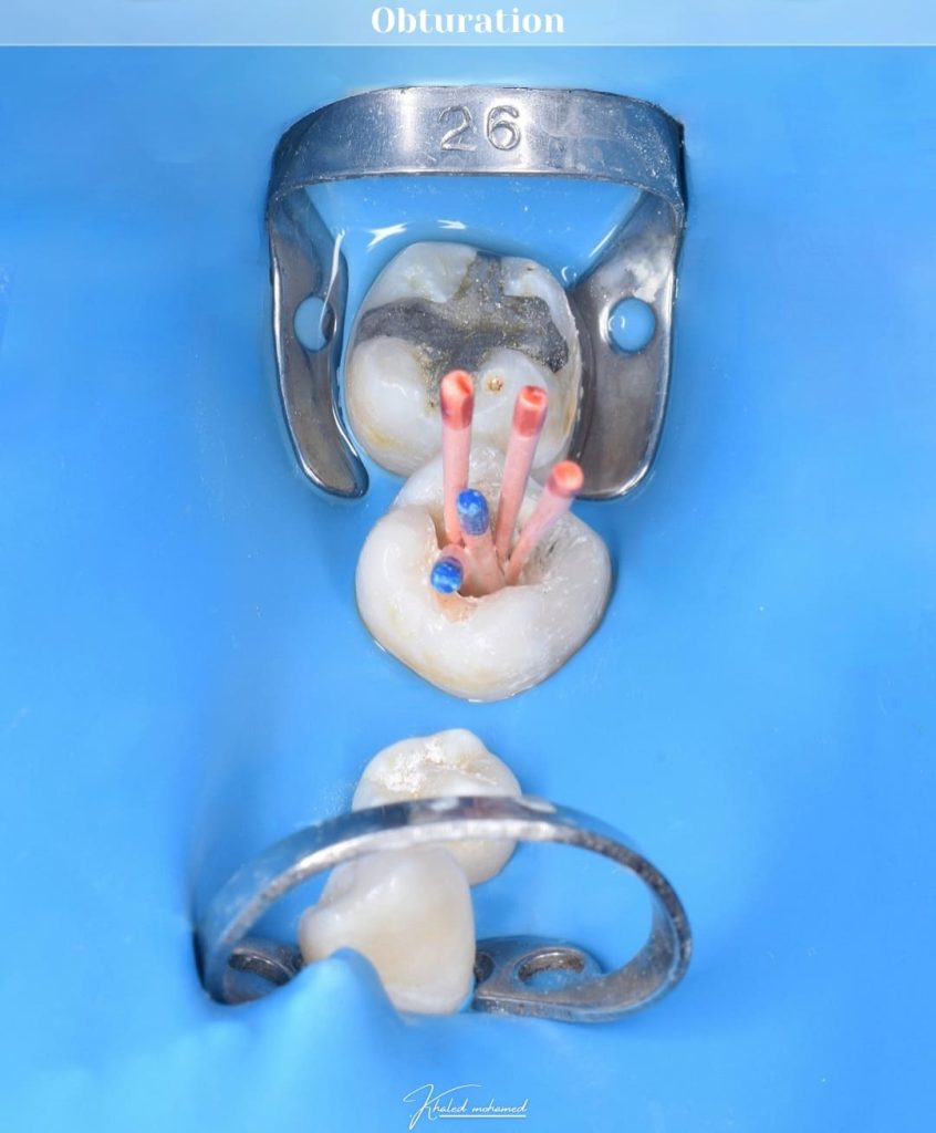 Obturation