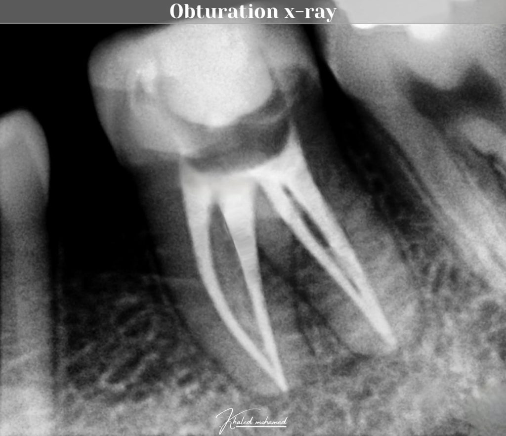 Obturation x-ray