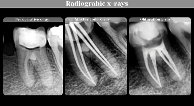 RCT x-rays collection