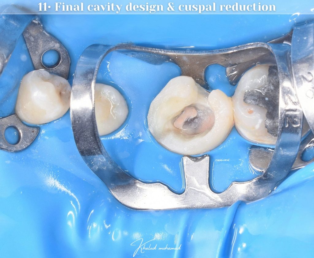 Final cavity design - Cusp reduction