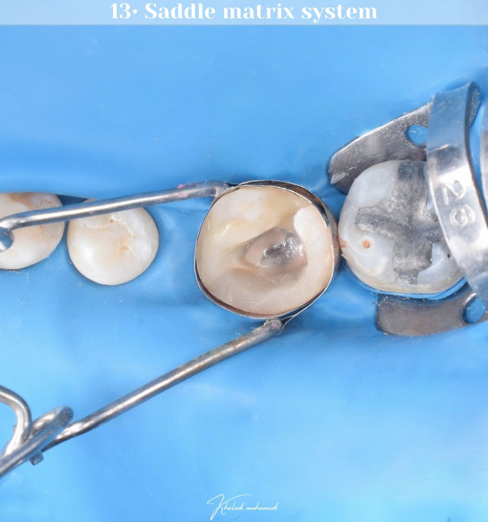 Saddle matrix system