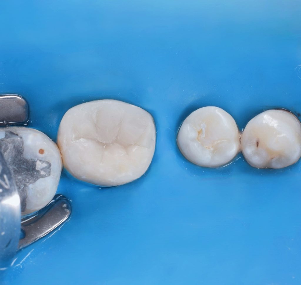 Carving composte build up after curing