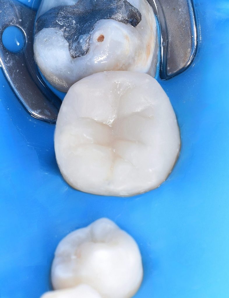 Direct shot after curing