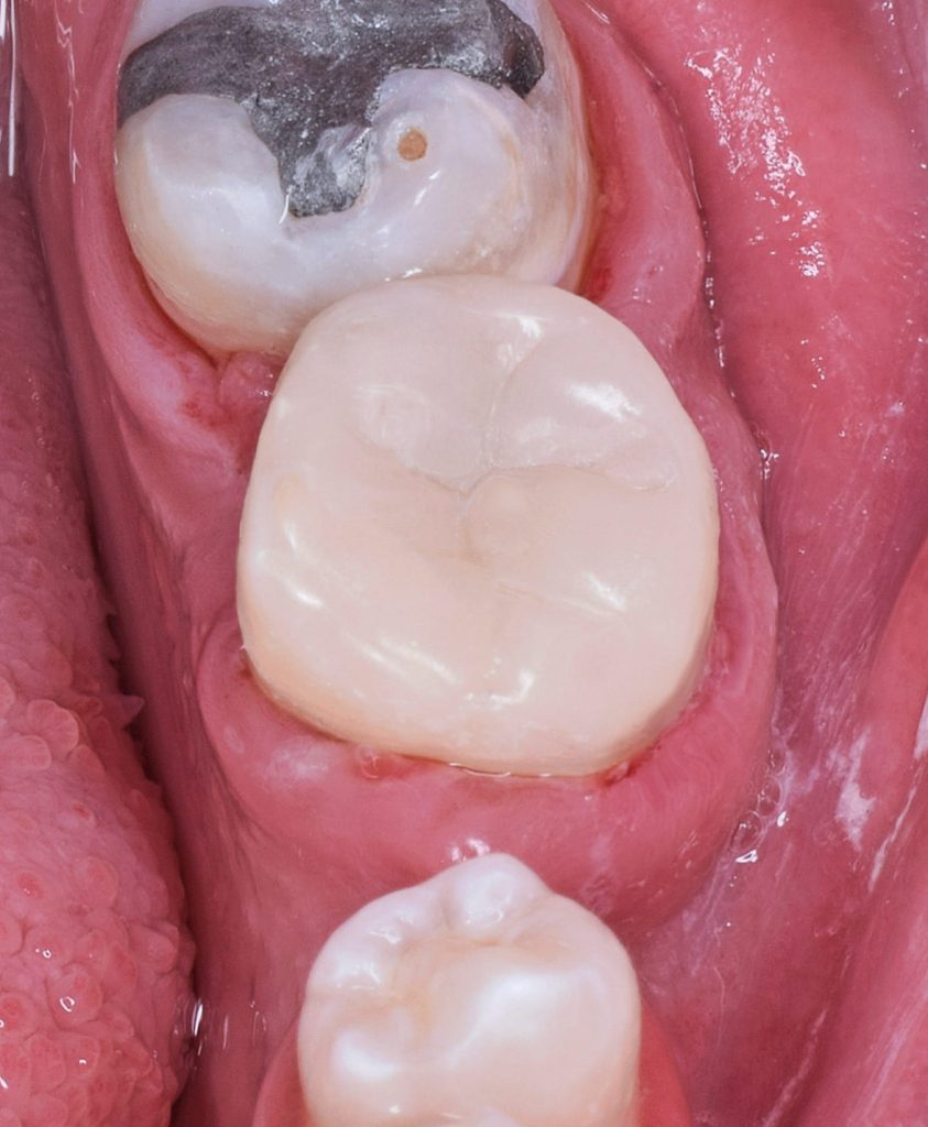 Direct shot final result