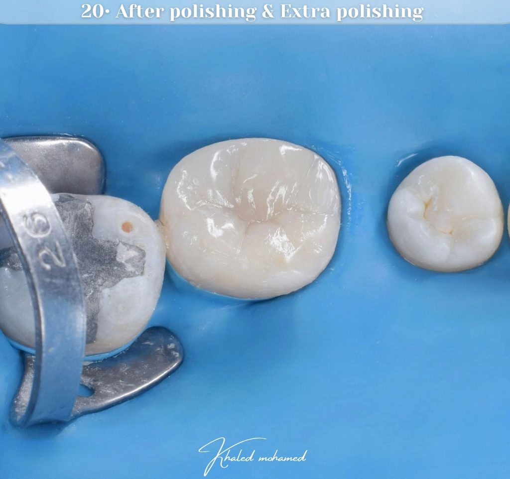 Polishing with eve twist kit