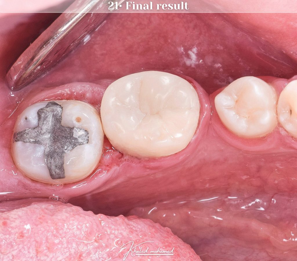 Final result after occlusal adjustment