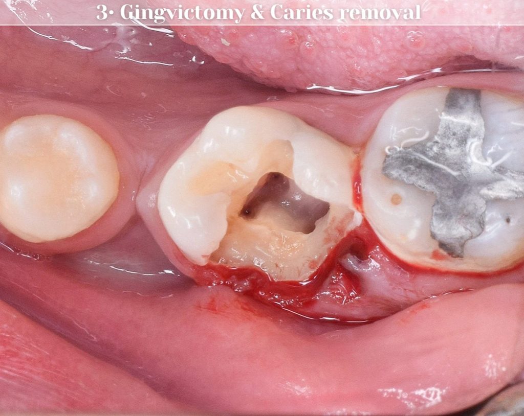Gingivectomy -  Gingival polyp removal
